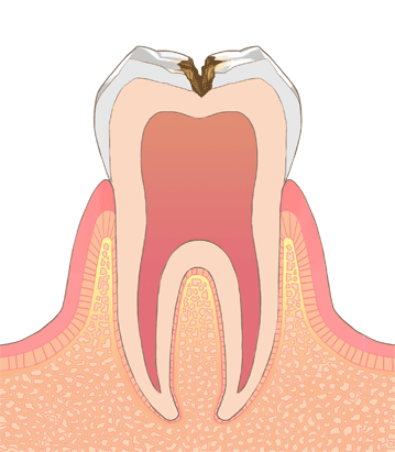 象牙質までの虫歯イラスト