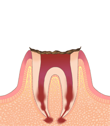 歯の質がほとんど残っていない虫歯イラスト
